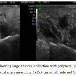 Figure 4: USG cheek showing large abscess /collection with peripheral increased vascularity seen in the bilateral buccal space measuring 5x2x4 cm on left side and 5.5x2.5 x4.4cm on right
