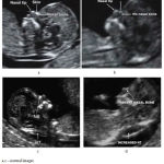 Figure 1: Normal and affected fetal images