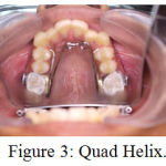 Figure 3: Quad Helix.