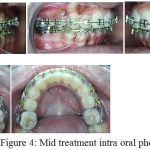 Figure 4: Mid treatment intra oral photos.