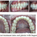 Figure 5: Post treatment intra oral photos with lingual retainers.