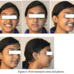 Figure 6: Post treatment extra oral photos.