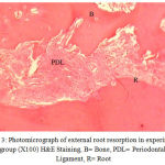 Figure 3: Photomicrograph of external root resorption in experimental group (X100) H&E Staining, B= Bone, PDL= Periodontal Ligament, R= Root