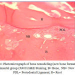 Figure 4: Photomicrograph of bone remodeling (new bone formation) in experimental group (X400) H&E Staining, B= Bone, NB= New Bone, PDL= Periodontal Ligament, R= Root