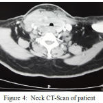 Figure 4: Neck CT-Scan of patient