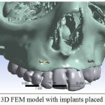 Figure 2: 3D FEM model with implants placed anteriorly
