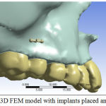 Figure 3: 3D FEM model with implants placed anteriorly