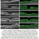 Figure 6: Images of Retinal Pathology (A) Scan SDOCT Choroidal Neovascular Membrane Image (CNVM).