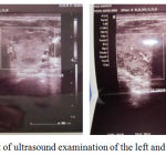 Figure 2: Result of ultrasound examination of the left and right thyroid of the patient