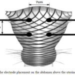 Figure 1: The electrode placement on the abdomen above the uterine surface [6]