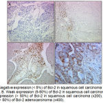 Figure 1: A. Negative expression (˂ 5%) of Bcl-2 in squamous cell carcinoma of the uterine cervix (x200). B. Weak expression (5-50%) of Bcl-2 in squamous cell carcinoma (x200). C. Moderate expression (˃ 50%) of Bcl-2 in squamous cell carcinoma (x200). D. Moderate expression (˃ 50%) of Bcl-2 adenocarcinoma (x400).