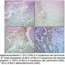 Immunohistochemical Expression of p53 and Bcl-2 in Algerian Cervical ...