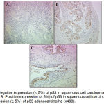 Figure 2: A. Negative expression (˂ 5%) of p53 in squamous cell carcinoma of the uterine cervix (x200). B. Positive expression (≥ 5%) of p53 in squamous cell carcinoma (x200). C. Positive expression (≥ 5%) of p53 adenocarcinoma (x400).