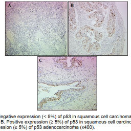Immunohistochemical Expression of p53 and Bcl-2 in Algerian Cervical ...