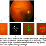 Figure 4: Original Image marked with exudates present (a) Enlarged version of marked area (b) Detection result of the proposed method (c) Detection result on original image (d) Proposed method detection (by green) and ground truth (by red) on original image.