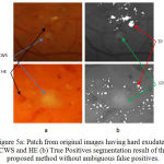 Figure 5.a: Patch from original images having hard exudates, CWS and HE (b) True Positives segmentation result of the proposed method without ambiguous false positives.