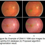 Figure 9a: Example of 2544 X 1696 size images form e-ophtha EX database (b) Proposed algorithm segmentation result.