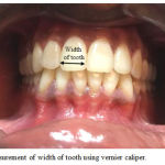 Figure 2: Measurement of width of tooth using vernier caliper.