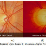 Figure 1a: Normal Optic Nerve b) Glaucoma Optic Nerve