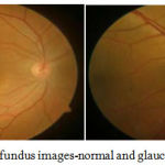 Figure 2: Typical fundus images-normal and glaucoma