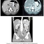 Figure 3: Contrast CT scan abdomen showed bilateral upper kidney mass