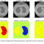 Figure 3: Visual results of applying the SRM segmentation algorithm to three continuous slices of a lung CT data.