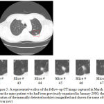 Figure 5: A representative slice of the follow-up CT image captured in March 2000 (upper slice) from the same patient who had been previously examined in January 2000; the approximate location of the manually detected nodule is magnified and shown for some of the other slices (lower row).