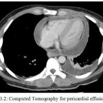 Figure 3.2: Computed Tomography for pericardial effusion [17].