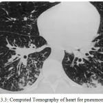 Figure 3.3: Computed Tomography of heart for pneumonia [18].