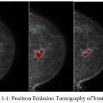 Figure 3.4: Positron Emission Tomography of breast [21].