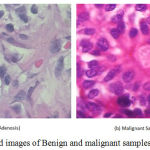 Figure 1: H&E stained images of Benign and malignant samples at 400X zoom.