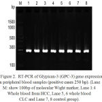 Figure 2. RT-PCR of Glypican-3 (GPC-3) gene expression in peripheral blood samples (positive cases 250 bp). (Lane M: show 100bp of molecular Wight marker, Lane 1:4 Whole blood from HCC, Lane 5, 6 whole blood CLC and Lane 7, 8 control group).