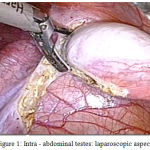 Figure 1: Intra - abdominal testes: laparoscopic aspect.