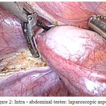 Figure 2: Intra - abdominal testes: laparoscopic aspect.