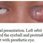 Figure 1: Clinical presentation. Left orbit with tumor mass that covered the eyeball and protrude from the orbit. Right orbit with prosthetic eye.