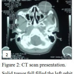 Figure 2: CT scan presentation. Solid tumor full filled the left orbit.