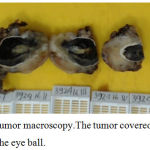 Figure 3: Tumor macroscopy.The tumor covered and infiltrated the eye ball.