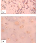 Figure 5: Vimentin and S100 protein immunostaining. a. Vimentine positive in eosinophillic tumor cells, b. S100 positive in hyaline certilage cells.