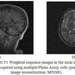 Figure 7: MRI T1 Weighted sequence images in the axial and sagittal view acquired using multiple Phase Array coils (parallel image reconstruction: SENSE).