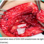 Figure 4: Intraoperative views of SAN-SSN anastomosis via right posterior approach (black arrow).