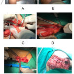 Figure 5(A-F): Intraoperative view performing the 2nd- 4th intercostal nerve to musculocutaneus nerve (ICN-MCN) anastomosis using sural nerve graft.