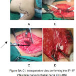 Figure 6(A-D): Intraoperative view performing the 5th- 6th intercostal nerve to Radial nerve (ICN-RN) anastomosis using sural nerve graft.