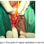 Figure 1: Free graft of vaginal epithelium is harvested.