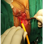 Figure 2: A suprameatal incision is made.