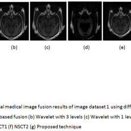 Multimodal Medical Image Fusion Using Guided Filter in NSCT Domain ...