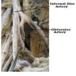 Figure 1: origin of obturator artery from posterior division of internal ilac artery