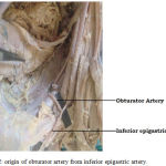 Figure 2: origin of obturator artery from inferior epigastric artery.