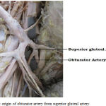 Figure 3: origin of obturator artery from superior gluteal artery.