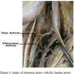 Figure 4: origin of obturator artery with ilio lumbar artery.
