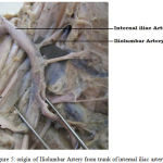 Figure 5: origin of Iliolumbar Artery from trunk of internal iliac artery